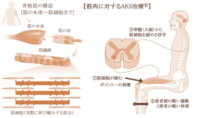 筋肉に対するAKS治療（筋細胞リリース）の説明イラスト